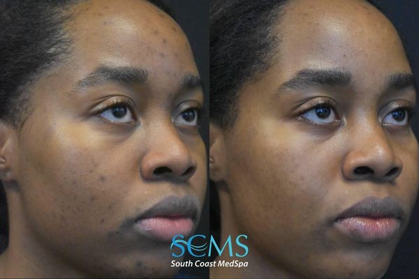 pm pico (2) Female patient with Fitzpatrick skin type V before and after 2 PicoSure treatments showing clearer skin, reduced blemishes, improved texture, and more balanced complexion
