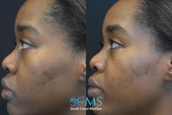 pm pico (3) Side profile of female patient, Fitzpatrick skin type V, before and after 2 PicoSure treatments showing reduction in acne, softened post-acne marks, and more even skin tone