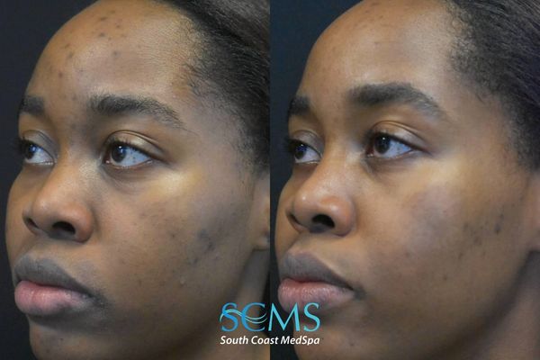 pm pico (4) Angled view of female patient with Fitzpatrick skin type V before and after 2 PicoSure treatments demonstrating improvement in acne breakouts, smoother skin texture, and reduced pigmentation