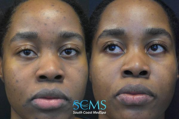 pm pico (5) Female patient, Fitzpatrick skin type V, before and after 2 PicoSure treatments showing reduction in active acne, improvement in forehead pigmentation, and more even overall skin tone