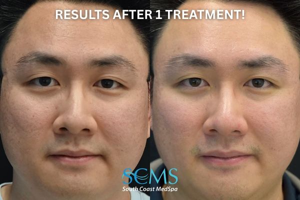 id ASR (1) (1) Front view of male patient with Fitzpatrick skin type III–IV before and after UltraClear ASR with PRP and Lumecca showing clearer skin, reduced redness, more even tone, and smoother overall complexion. Photo states Results after 1 Treatment