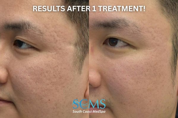 id ASR (2) (2) Side view of male with Fitzpatrick skin type III–IV before and after UltraClear ASR, PRP, and Lumecca demonstrating refined skin texture, less visible pores, and softened acne scars. Photo states Results after 1 Treatment