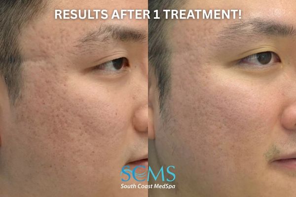 id ASR (3) (1) Male patient with Fitzpatrick skin type III–IV before and after UltraClear ASR with PRP and Lumecca showing smoother skin texture, reduced pore appearance, and improvement in mild acne scarring on the cheek. Photo states Results after 1 Treatment