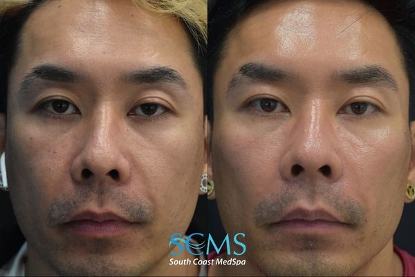 tt pico (1) Before and after front facial view demonstrating improved skin tone, reduced pigmentation irregularities, and overall facial skin rejuvenation following four Pico skin revitalization treatments at South Coast MedSpa.