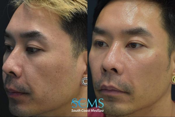 tt pico (2) Before and after left front facial view highlighting enhanced skin clarity, more even pigmentation, and smoother skin texture after four Pico skin revitalization treatments.