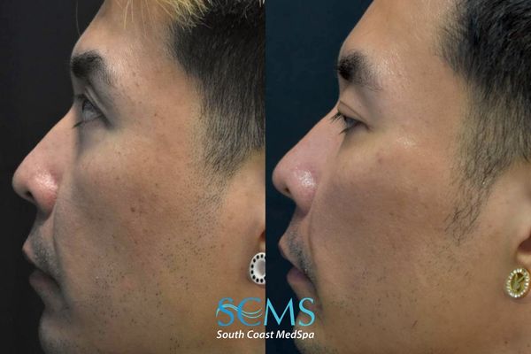 tt pico (3) Before and after left side profile showing improvement in skin tone, pigmentation concerns, and overall skin quality following four Pico skin revitalization treatments at South Coast MedSpa.