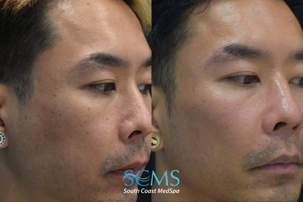tt pico (4) Before and after right front facial view demonstrating reduced pigmentation irregularities, smoother skin texture, and improved complexion after four Pico skin revitalization treatments.