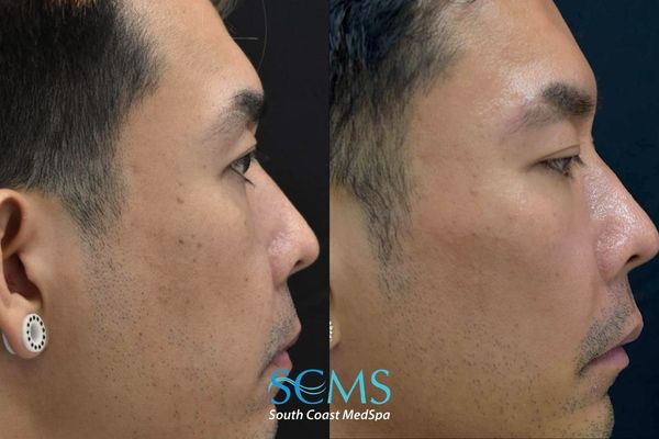 tt pico (5) Before and after right side profile showing improvement in facial pigmentation, skin tone, and overall skin clarity following four Pico skin revitalization treatments at South Coast MedSpa.