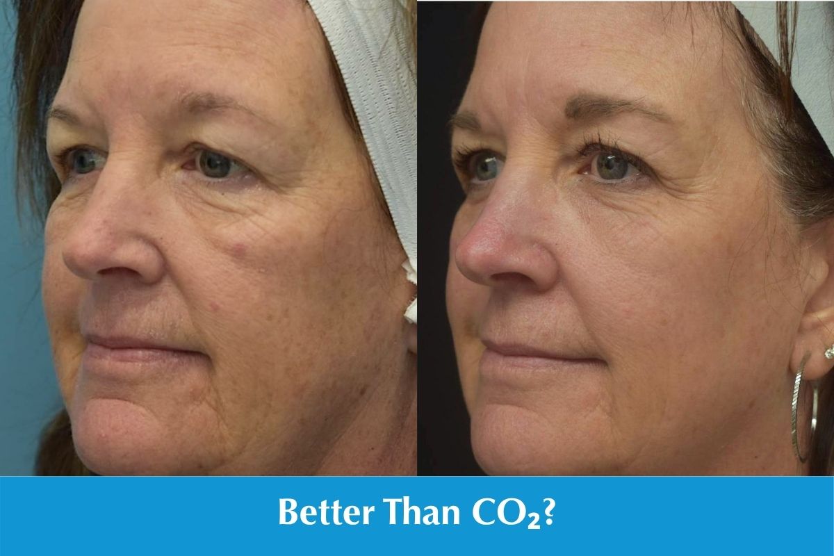 Side-by-side before-and-after photos showing smoother, more even-looking skin after one Laser-Coring treatment, with text reading “Better Than CO₂?”