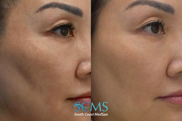 wh pico (1) Before-and-after right profile showing reduced dark spots and more even-looking skin after PicoSure Skin Revitalization at South Coast MedSpa.