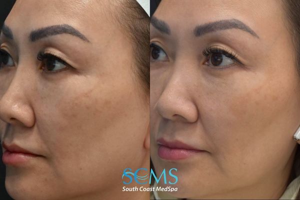 wh pico (2) Before-and-after left profile showing improved pigmentation, skin clarity, and overall tone after PicoSure Skin Revitalization at South Coast MedSpa.