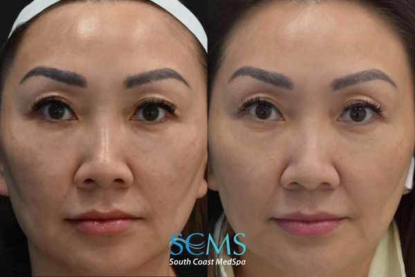 wh pico (3) Before-and-after front view showing reduced facial pigmentation and a more even skin tone after PicoSure Skin Revitalization at South Coast MedSpa.