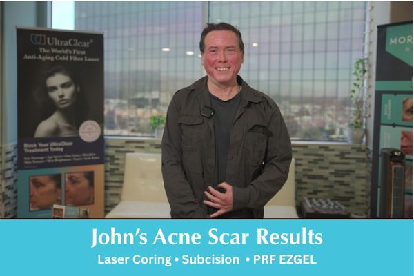 Video thumbnail showing John at South Coast MedSpa. Text: “John’s Acne Scar Results: Laser Coring • Subcision • PRF EZGEL.”