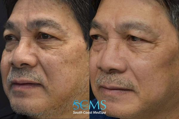 la pico (1) Side-by-side three-quarter before-and-after view showing reduced facial pigmentation and a clearer, more even-looking complexion after three PicoSure skin treatments.