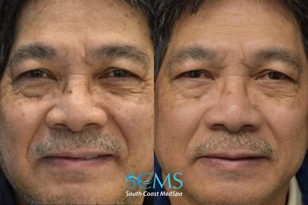 la pico (2) Front-view before-and-after photos showing visibly reduced dark spots and a brighter, more even-looking complexion after three PicoSure skin treatments.
