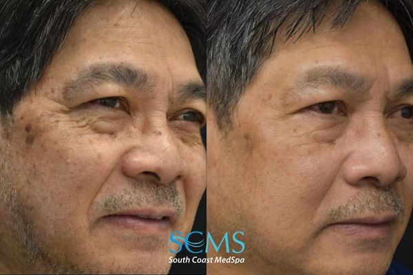 la pico (3) Side-by-side angled facial views showing significant improvement in dark spots and uneven pigmentation after three PicoSure skin treatments.