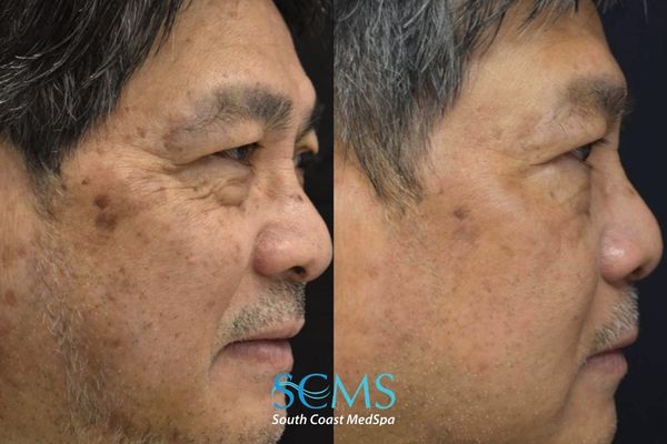 la pico (4) Side-profile before-and-after photos showing prominent dark spots along the temple and upper cheek visibly lightened after three PicoSure skin treatments.