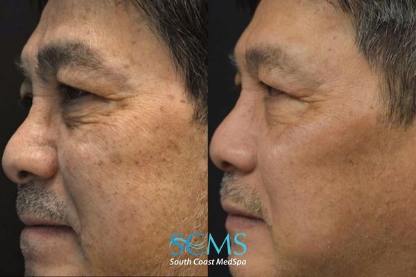 la pico (5) Side-profile before-and-after photos showing visibly reduced dark spots and cheek discoloration, with a clearer, more even-looking complexion after three PicoSure skin treatments.
