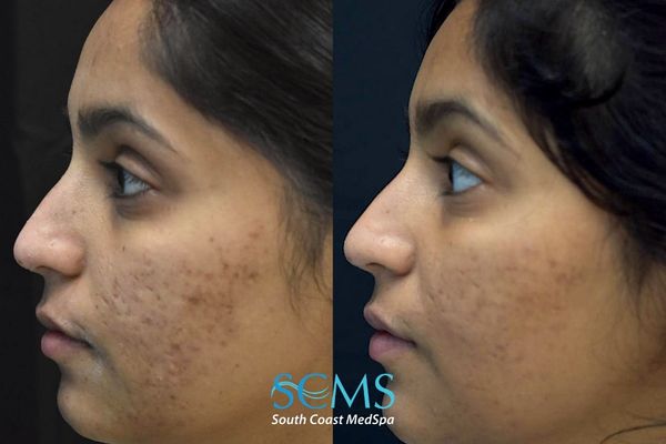 ps ASR+pico (3) Before and after opposite side-profile view showing smoother acne-scar texture after two UltraClear acne scar removal treatments with PRP and subcision, plus two Pico skin treatments
