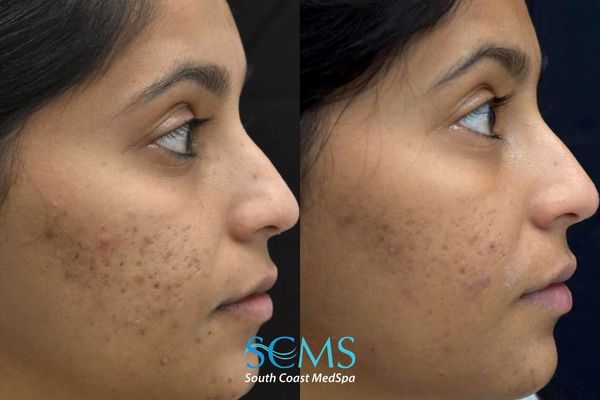 ps ASR+pico (5) Before and after side-profile acne scar improvement following two UltraClear acne scar removal treatments with PRP and subcision, plus two Pico skin treatments.