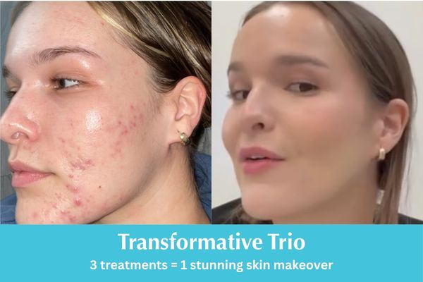 Video thumbnail showing Sofia’s acne and skin transformation. Text: “Transformative Trio: 3 treatments = 1 stunning skin makeover.”